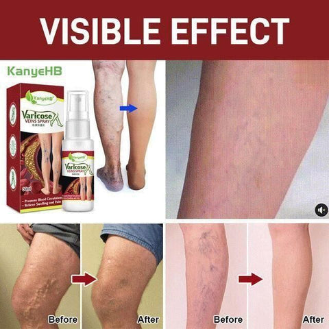Veinhealing Varicose Veins Treatment Spray (Pack of 2)