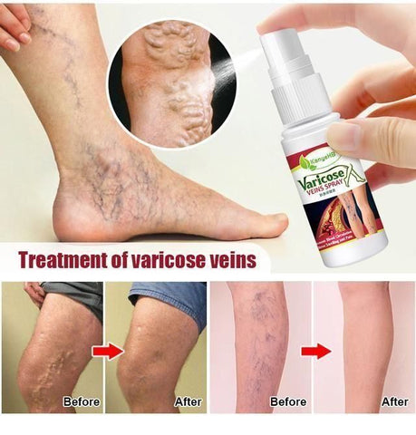 Veinhealing Varicose Veins Treatment Spray (Pack of 2)